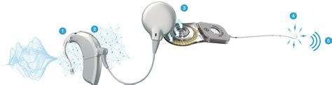 What Is A Cochlear Implant Advanced Bionics