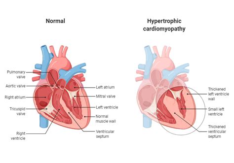 Hypertrophic Cardiomyopathy | BioRender Science Templates