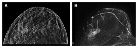 Imaging In Locoregional Management Of Breast Cancer Journal Of Clinical Oncology