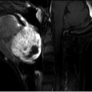 Contrast Enhanced Axial T1 Weighted Magnetic Resonance Imaging Showing