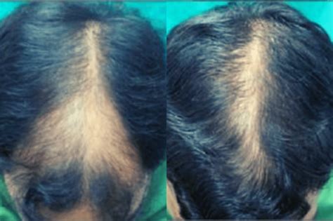 Microneedling For Hair Loss Pro Needling