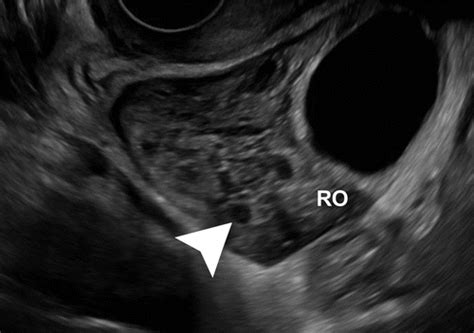 Adnexal Torsion Review Of Radiologic Appearances Radiographics