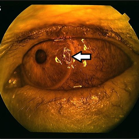 A And B Anterior Segment Slit Lamp Photograph Of The Left Eye Showing