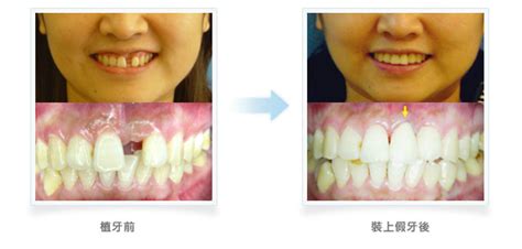 水雷射植牙 植牙新技術 植牙 台北市植牙│人工植牙│牙齒矯正│牙周病│顯微根管治療~推薦【印象牙醫診所】水雷射牙周病治療、顯微