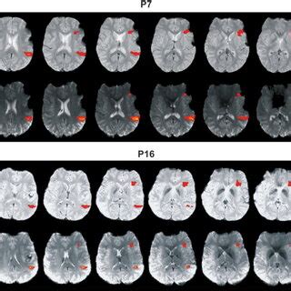 Broca/Wernicke behavior of the functional activation measures (compare ...