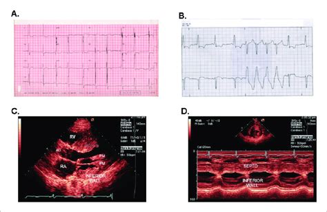 A Electrocardiogram Shows Left Ventricular Overload B Hour Holter