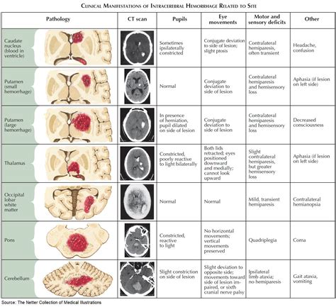 Intracerebral Hemorrhage