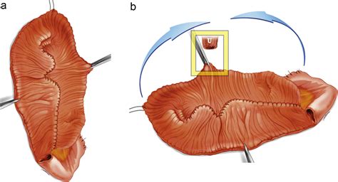 Robotic Intracorporeal Orthotopic Ileal Neobladder Replicating Open