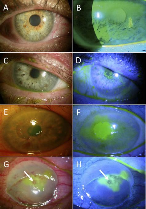 Figure 3 From Update On Cenegermin Eye Drops In The Treatment Of Neurotrophic Keratitis