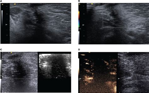 Frontiers Multimodal Ultrasonography Findings Of Extramammary