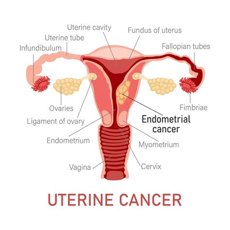 Uterine Cancer Diseases Of The Female Reproductive System Gynecology