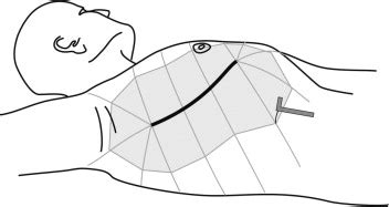 Different Anesthetic Techniques Associated With Different Incidences Of