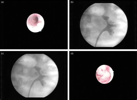 Retrograde Ureteroscopy In The Treatment Of Caliceal Diverticula