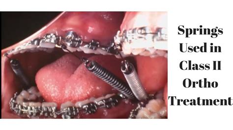 Springs Used In Class Ii Orthodontic Treatment Youtube