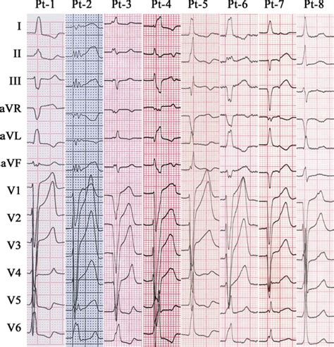 Idiopathic Accelerated Idioventricular Rhythm Or, 44% OFF