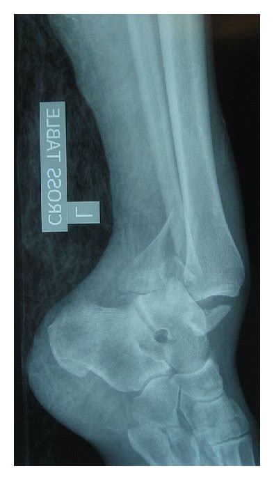 Initial Anteroposterior And Lateral Radiographs Showing An Ankle Download Scientific Diagram