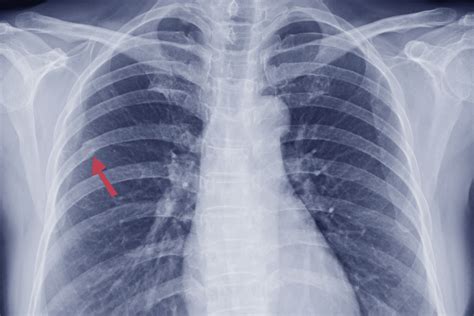 Neumark Treatment for Chronic Rib Fractures with Internal Rib Fixation