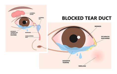 Blocked Tear Duct Upper Eyelid