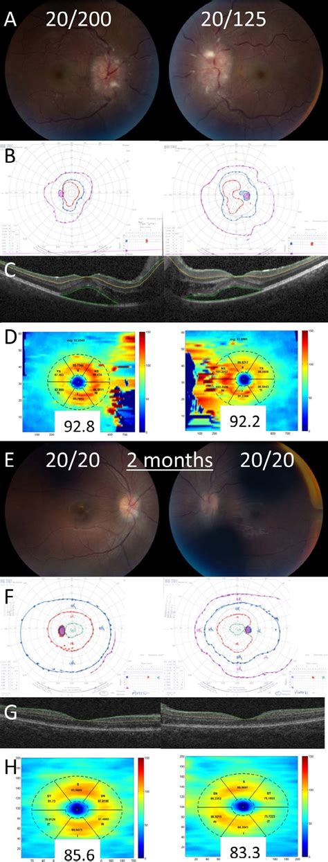 Example Of A Patient With Decreased Visual Acuity From Subretinal Download Scientific Diagram