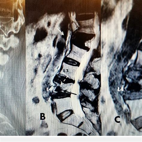 Progression of L4 inferior endplate fracture after vertebral ...