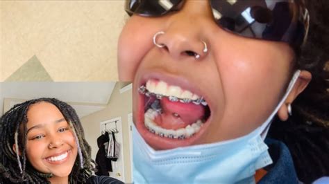 Vlog Getting My Braces Off After Years Youtube