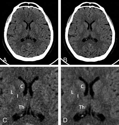 Photon Counting Ct Of The Brain In Vivo Human Results And Image