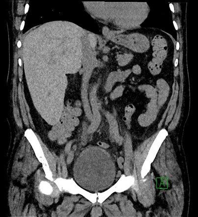 Sickle Cell Disease Abdominal Manifestations Image Radiopaedia Org