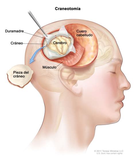 Cómo afectan las fases del sueño si tienes un tumor cerebral