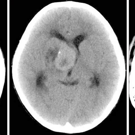 Basal Ganglia Calcification Mri