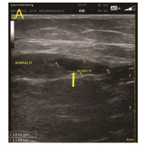 Ultrasound Classification Criteria For Muscle Injury—a Case With A Download Scientific Diagram