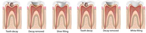 Dental Filling Shinagawa Orthodontics Philippines