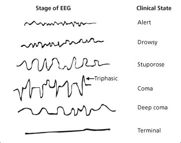 8 Hepatic Encephalopathy in Patients with Cirrhosis | Abdominal Key