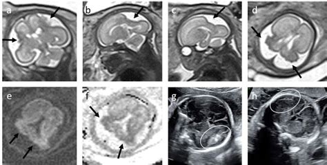 The Role Of Fetal Brain Magnetic Resonance Imaging In Current Fetal