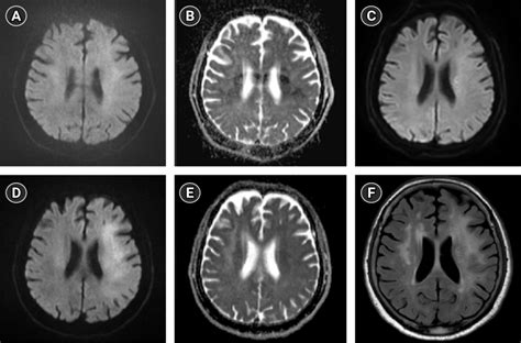 Magnetic Resonance Imaging Findings In Case 1 Diffusion Weighted