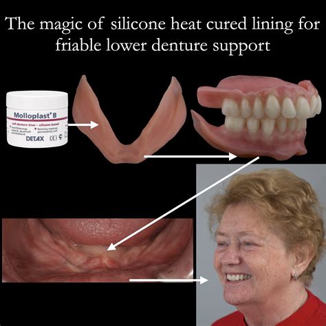 The Magic Of A Heat Cured Soft Lining For Lower Complete Dentures