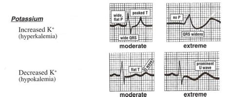 Hypokalemia Hyperkalemia Ecg