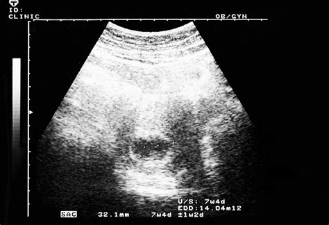 7 Weeks Pregnant Ultrasound: Procedure, Abnormalities and More