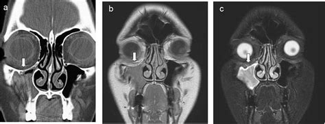 Silent Sinus Syndrome Ct And Mri Findings Bmj Case Reports