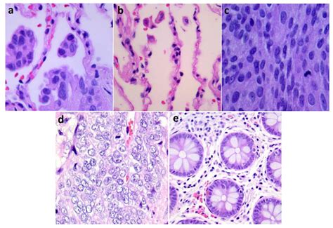 Sample Lung And Colon Cancer Histopathological Images From Lc25000 Download Scientific Diagram