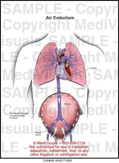 Air Embolism Medical Illustration Medivisuals