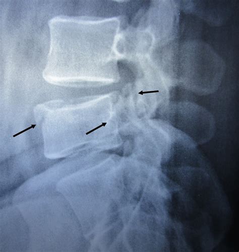 Chances Fracture