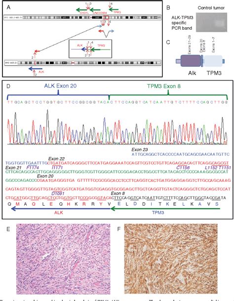 Figure 3 From Chromoplectic TPM3ALK Rearrangement In A Patient With