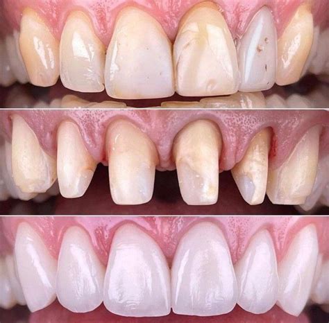 Naturally Whiten Teeth 10 Ways To Remove Tartar Stains From Your Teeth