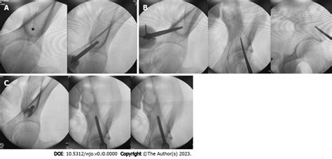 Intraoperative Fluroscopy Images Used To Insert The Internal Fixator