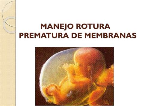 Ppt Ruptura Prematura De Membranas Powerpoint Presentation Id