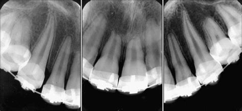 Severe root resorption and orthodontic treatment: Clinical implications after 25 years of follow ...