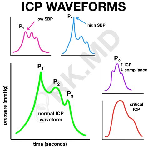 Measuring And Interpreting Intracranial Pressure (ICP) Waveforms | RK.MD