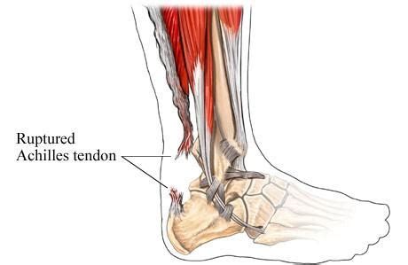 Repair Ruptured Achilles Tendon - Dr Greg Sterling