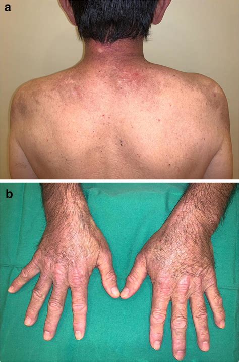 A Erythematous Rash Typical Of Dermatomyositis On The Patients Neck