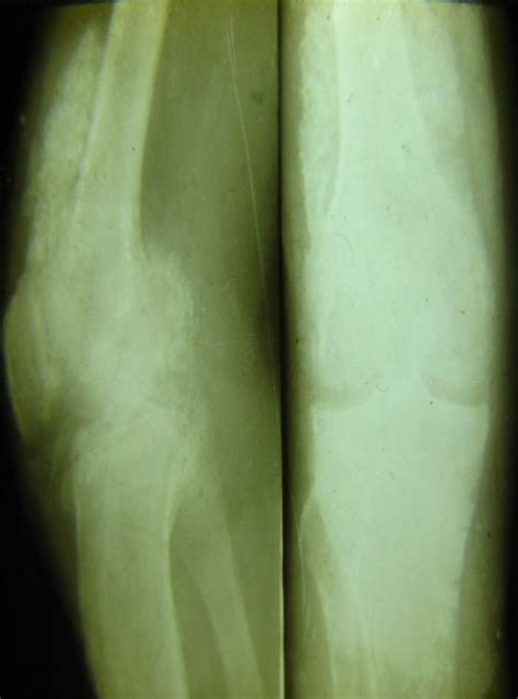 Female 32 years old. Synovial Osteochondromatosis of the right knee ...